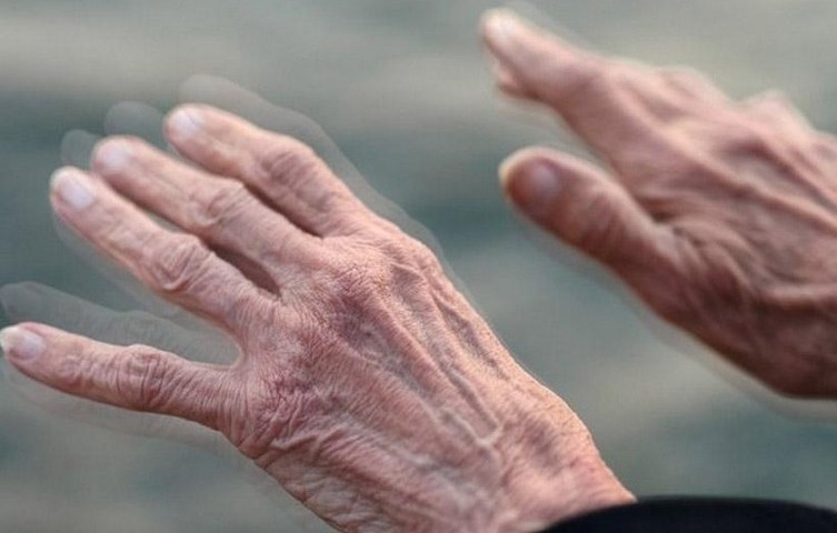 Noutăți în tratamentul Bolii Parkinson